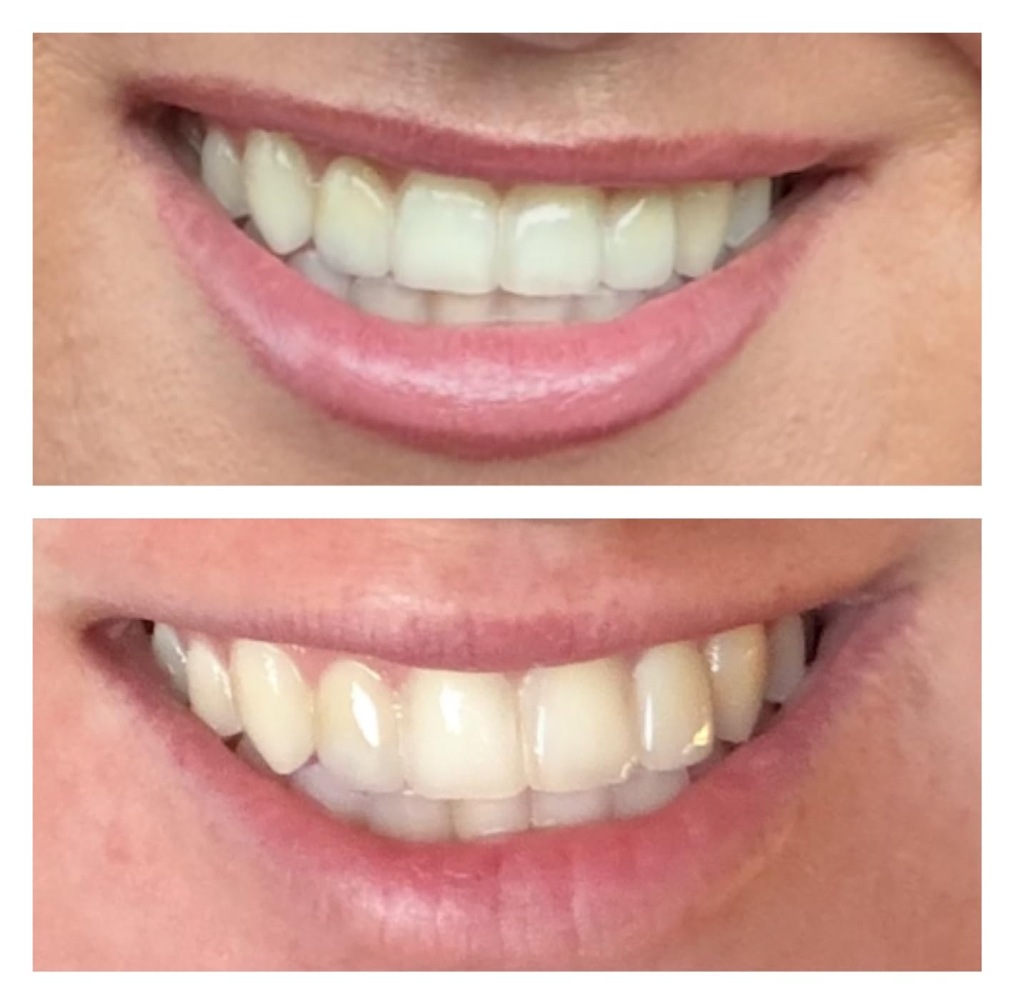 Opalescence Go 15% Mint - Prefilled Teeth Whitening Trays - Hydrogen Peroxide Formula (10 Treatments) - Dentist Developed - Low Sensitivity - Gentle on Enamel customer photo 1