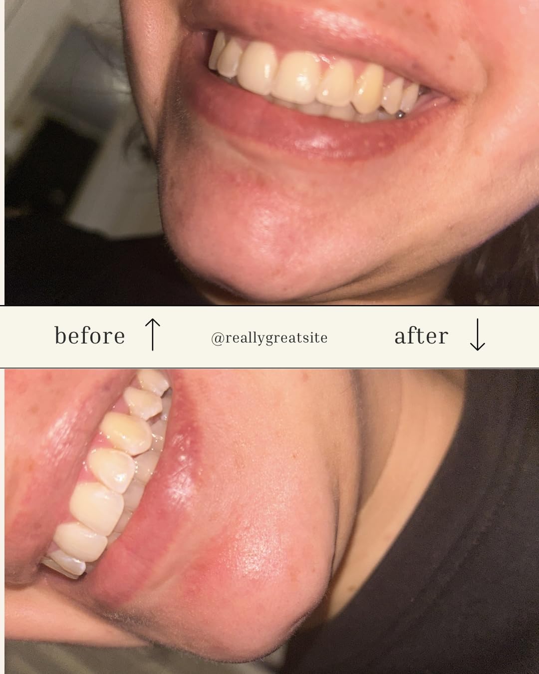 Auraglow Teeth Whitening Kit, LED Accelerator Light, 35% Carbamide Peroxide Teeth Whitening Gel, 20+ Whitening Treatments, Whitens up to 10 Shades in 7 Days customer photo 2
