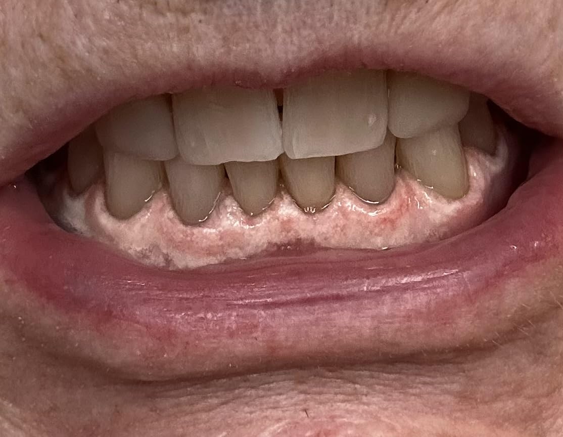 Auraglow 44% Teeth Whitening Gel for Trays, Retainers & Aligners - Dentist Strength Carbamide Peroxide Whitener, 30 Treatments, 3 Syringes (5mL) customer photo 1