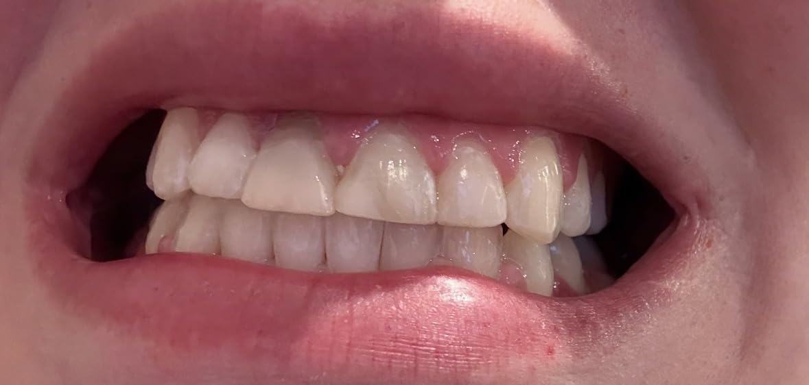 Crest Teeth Whitening Strips, Crest 3D Whitestrips Vivid Plus, Enamel Safe Teeth Whitening Kit, 12 Treatments (24 Strips), Visibly Whitens in Days, 8 Levels Whiter customer photo 1