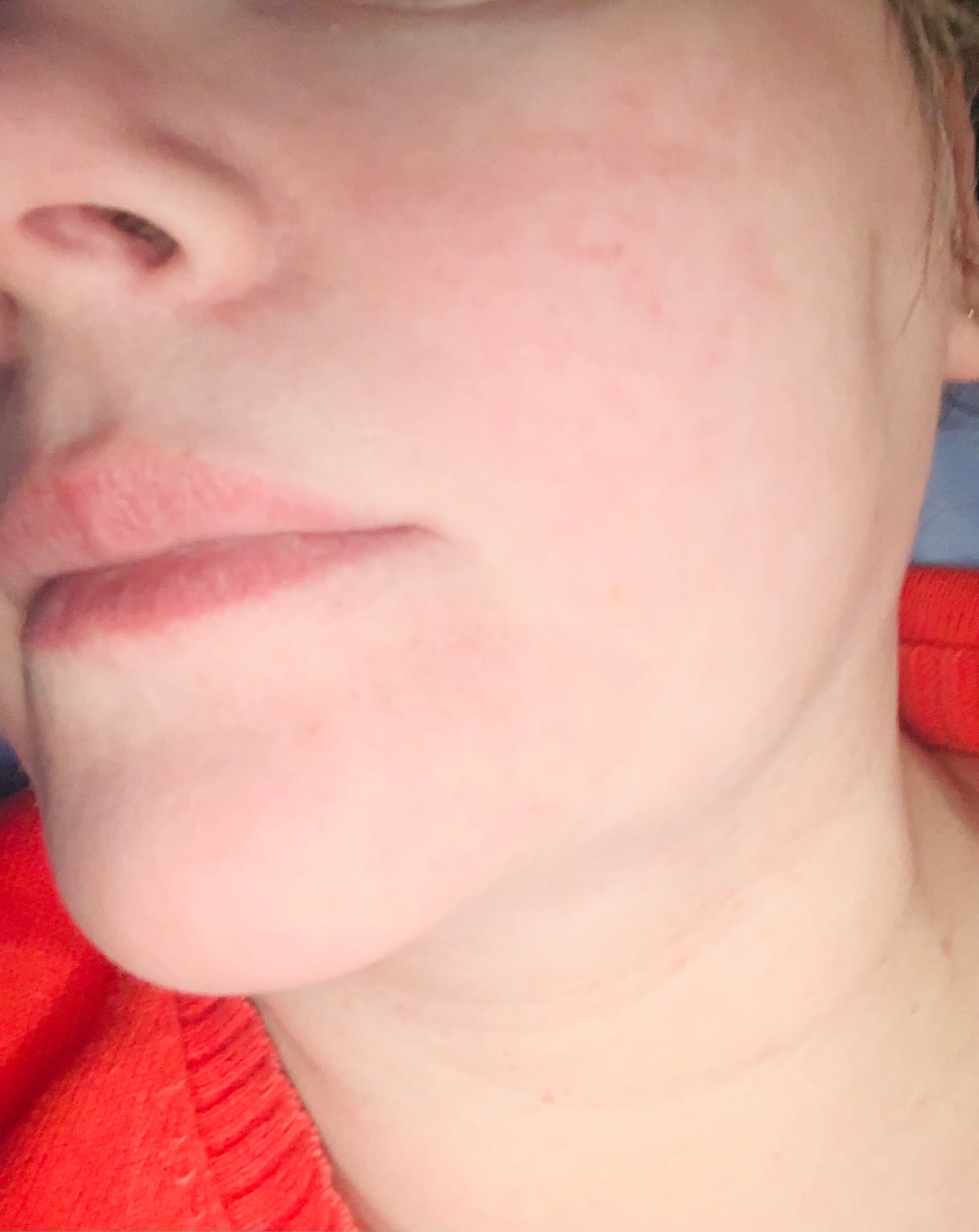 Trophy Skin MicrodermMD - At Home Microdermabrasion Kit - Anti Aging and Acne Treatment - Contains Real Diamond and Pore Extractor Tips to Rejuvenate Skin - White customer photo 1