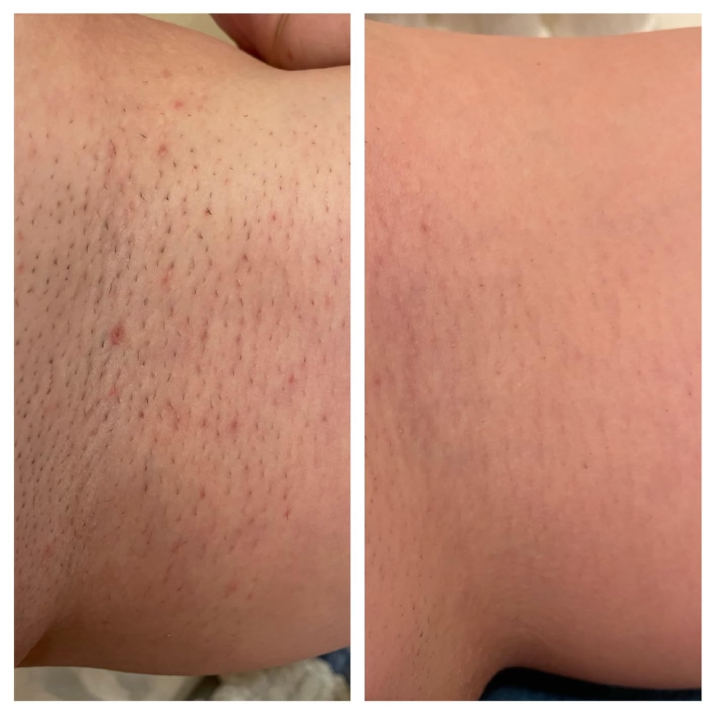Braun IPL, Silk-Expert Pro 5, IPL Hair Removal for Women and Men, Permanent Laser Hair Reduction At-Home, 2 Heads, Pouch, IPL5137 customer photo 2