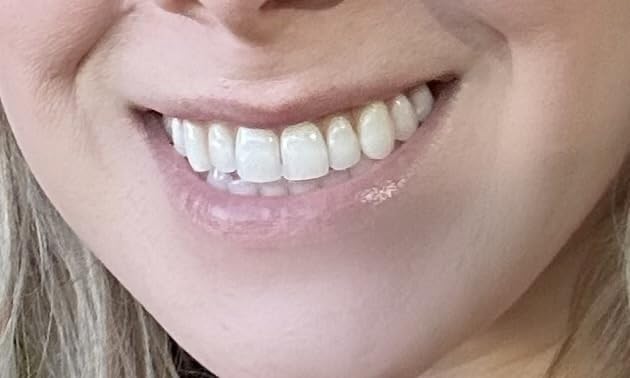 Colgate Optic White Overnight Teeth Whitening Pen, Teeth Stain Remover, Removes Years of Stains in Just 1 Week, Enamel Safe, Designed for No Tooth Sensitivity, 0.08 OZ customer photo 1