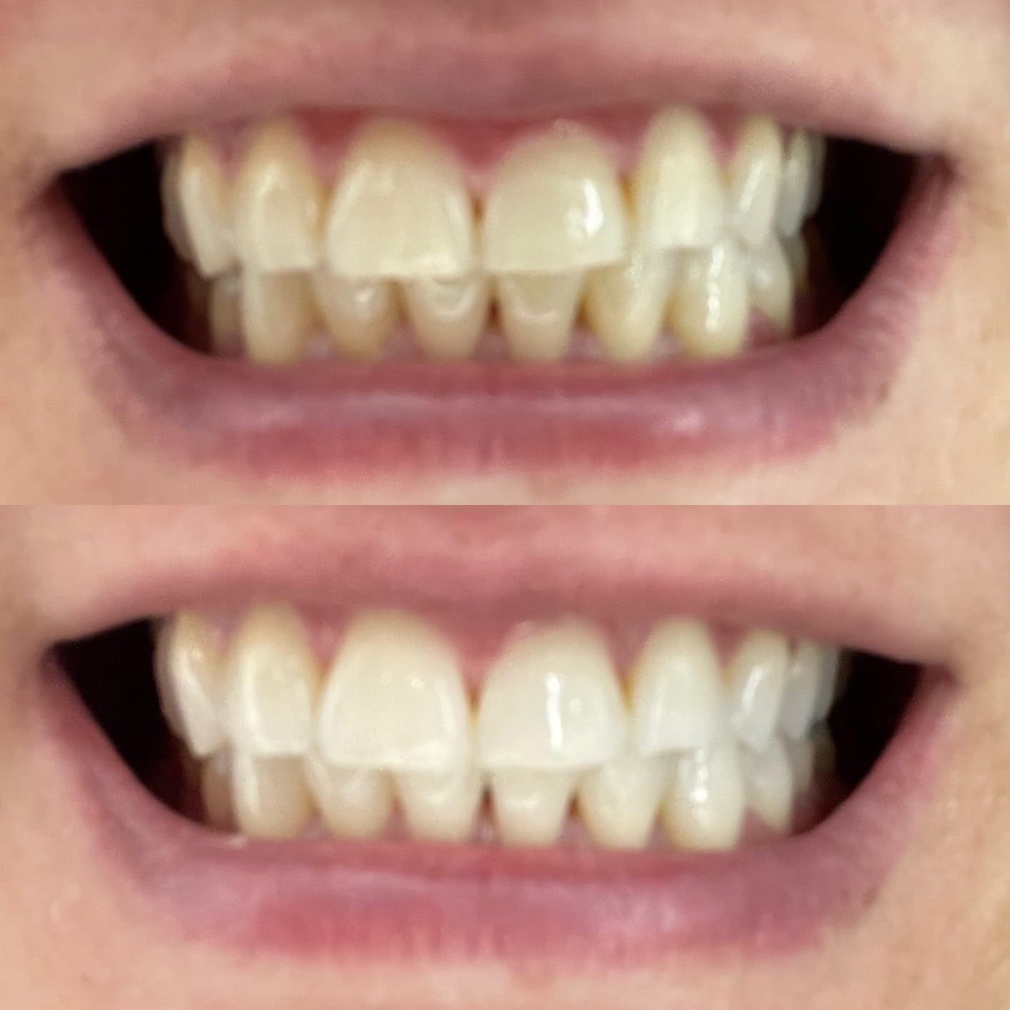 SmileDirectClub Teeth Whitening Kit with LED Light - 4 Pack Gel Pens - Professional Strength Hydrogen Peroxide customer photo 2