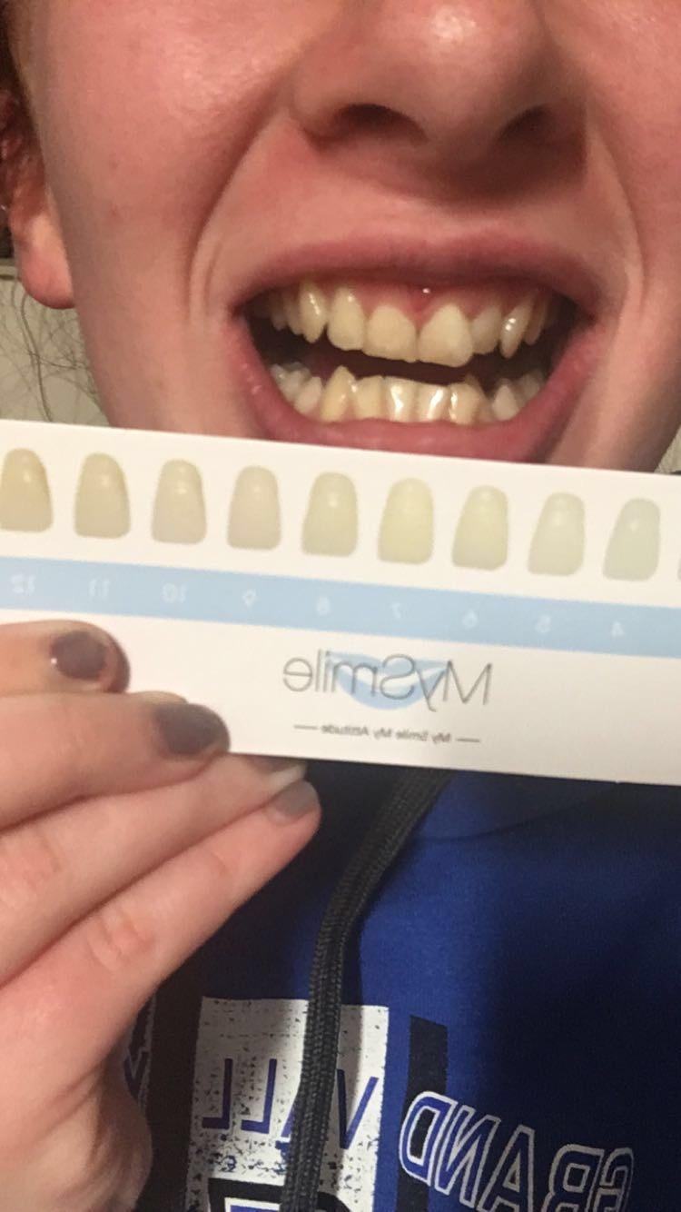 MySmile Teeth Whitening LED Light w/Mouth Tray Home Oral Whitening Device | Blue LED Boosts Teeth Whitening with 4ML Gel Capsule. Gentle on Teeth, Non-Sensitive, Portable for Home and Travel. customer photo 1