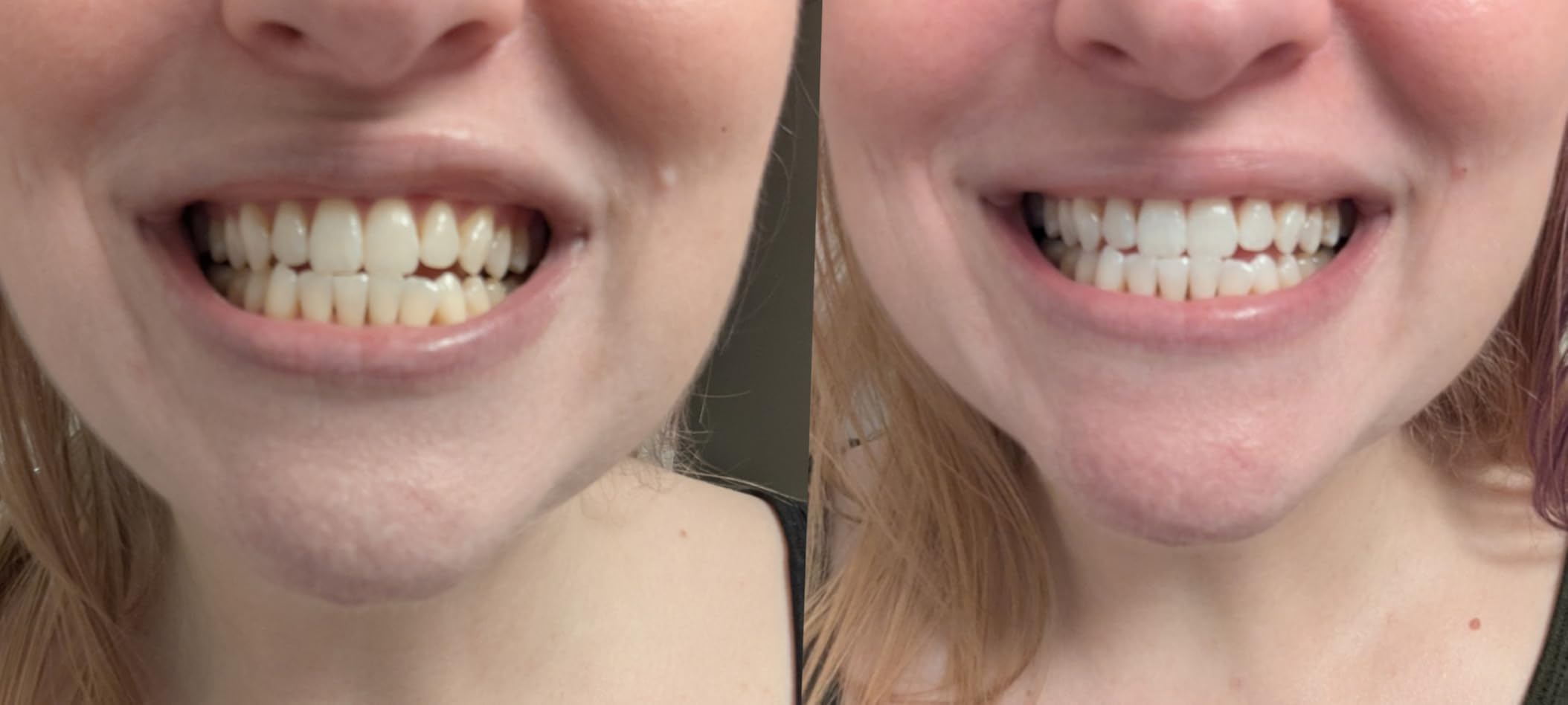 Crest 3D Whitestrips Professional Effects + LED Light – Teeth Whitening Kit, 1 Light + 20 Treatments, Each with 1 Upper/1Lower, 40 Strips – Crest 3DWhite Teeth Whitening Strips customer photo 2