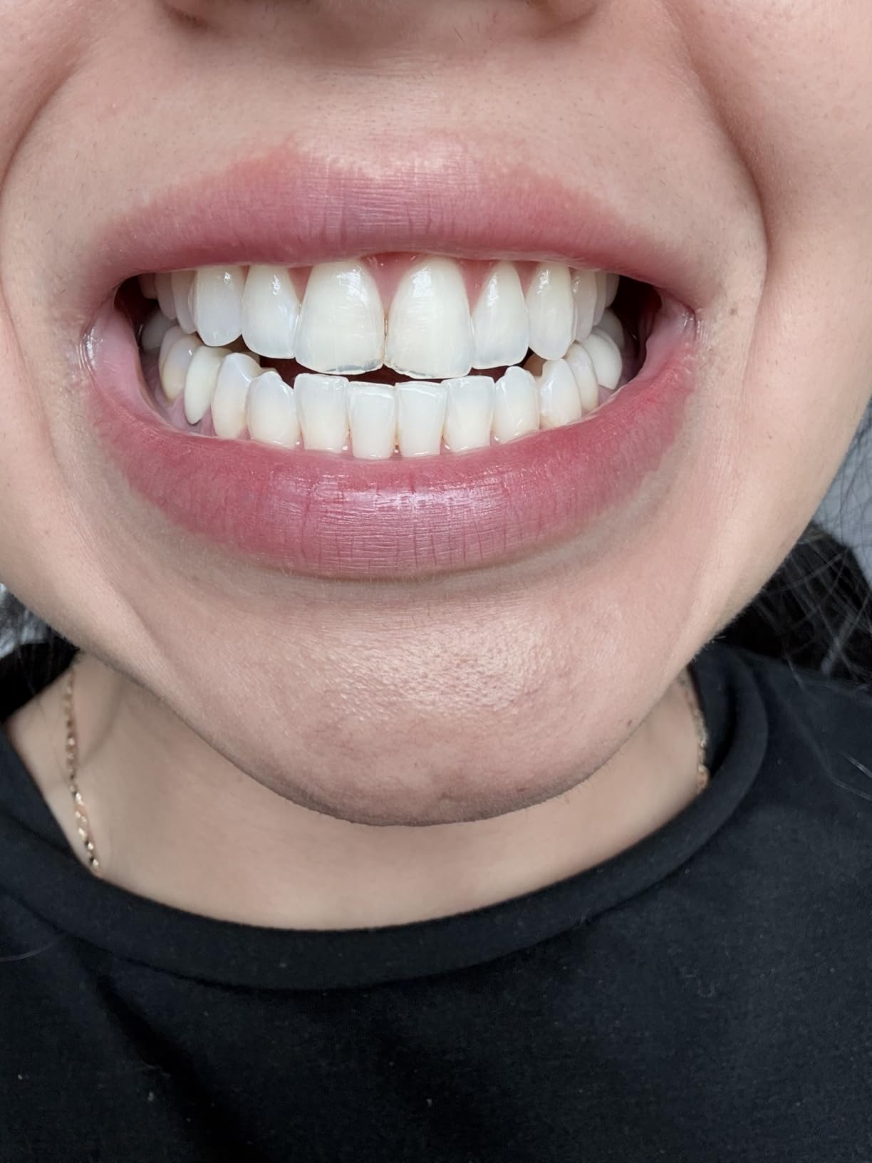 Crest 3DWhitestrips Sensitive White At-Home Teeth Whitening Kit, 18 Treatments, Gently Removes 15 Years of Stains customer photo 2