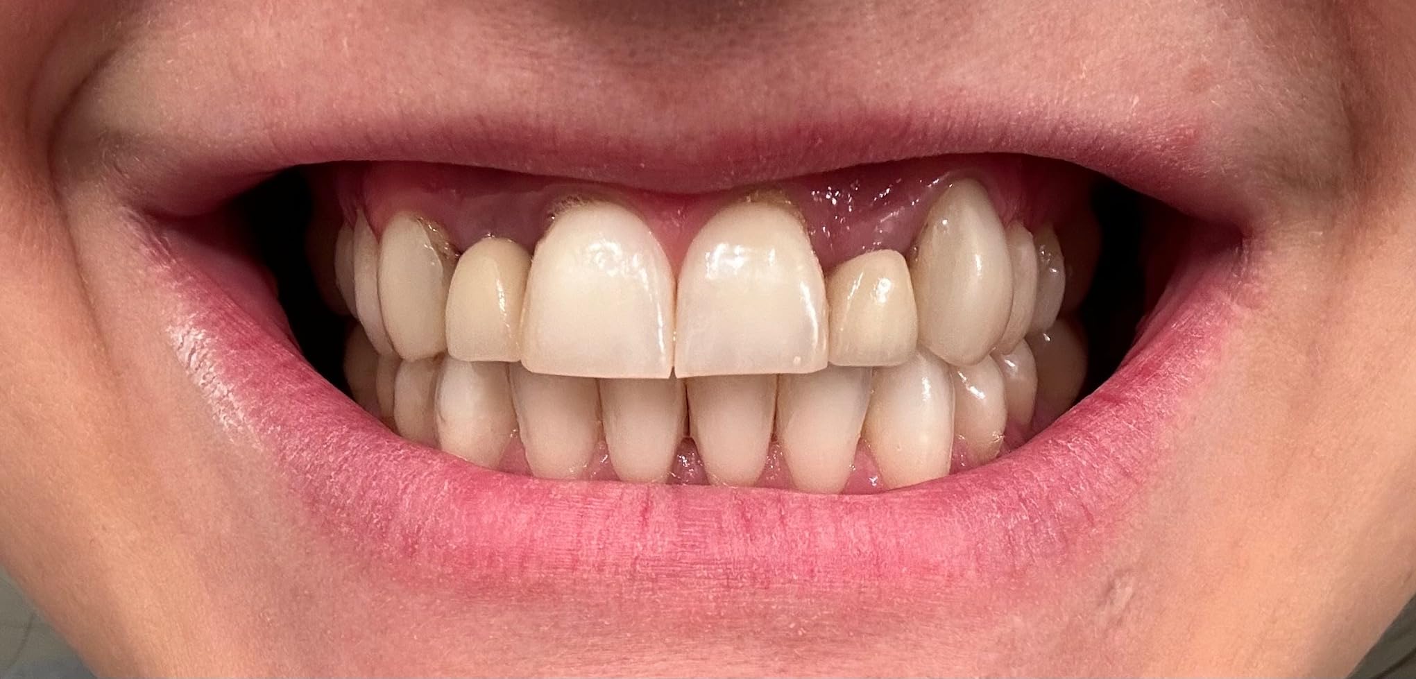 PurelyWHITE DELUXE Teeth Whitening Kit, Complete LED Teeth Whitening, 15+ Treatments, (3) 3ml Whitening Gel Syringes, Whiter Smile in 7 Minutes customer photo 1