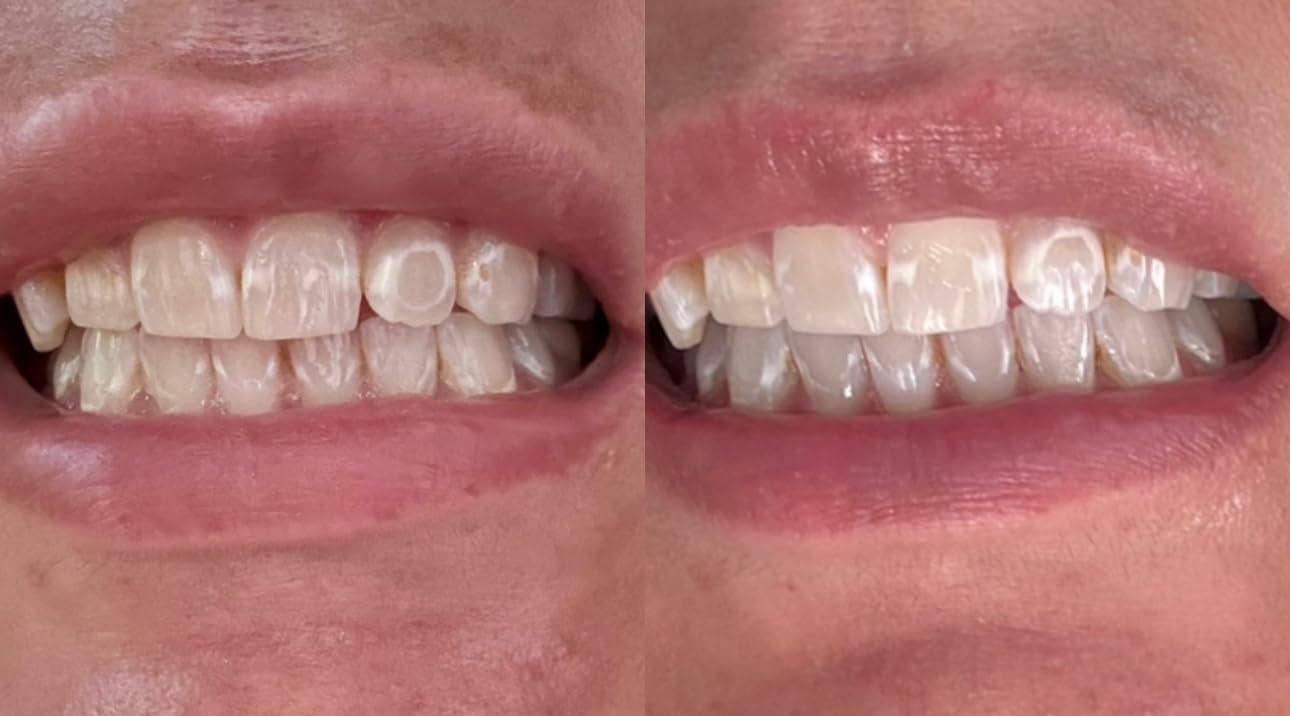 Crest 3D Whitestrips Sensitive & Gentle + LED Light - Teeth Whitening Kit, 1 Light + 14 Treatments, Each with 1 Upper/1Lower, 28 Strips customer photo 2
