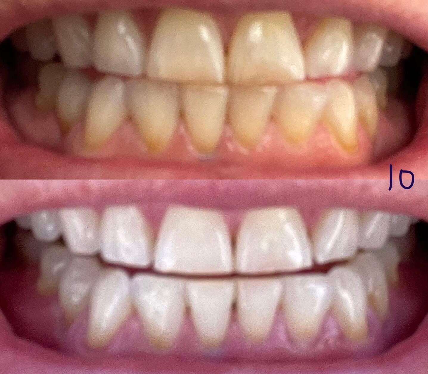 Auraglow Plug-in LED Teeth Whitening Kit - Wired Light Device - 35% Carbamide Peroxide Gel - 12 Treatments - at-Home Tooth Whitening System - Enamel-Safe at-Home Whitening for Coffee & Tea Stains customer photo 1