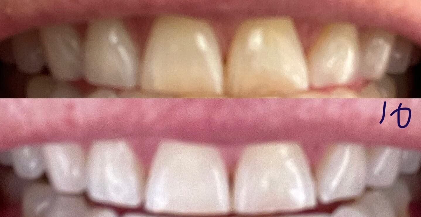 Auraglow Plug-in LED Teeth Whitening Kit - Wired Light Device - 35% Carbamide Peroxide Gel - 12 Treatments - at-Home Tooth Whitening System - Enamel-Safe at-Home Whitening for Coffee & Tea Stains customer photo 2