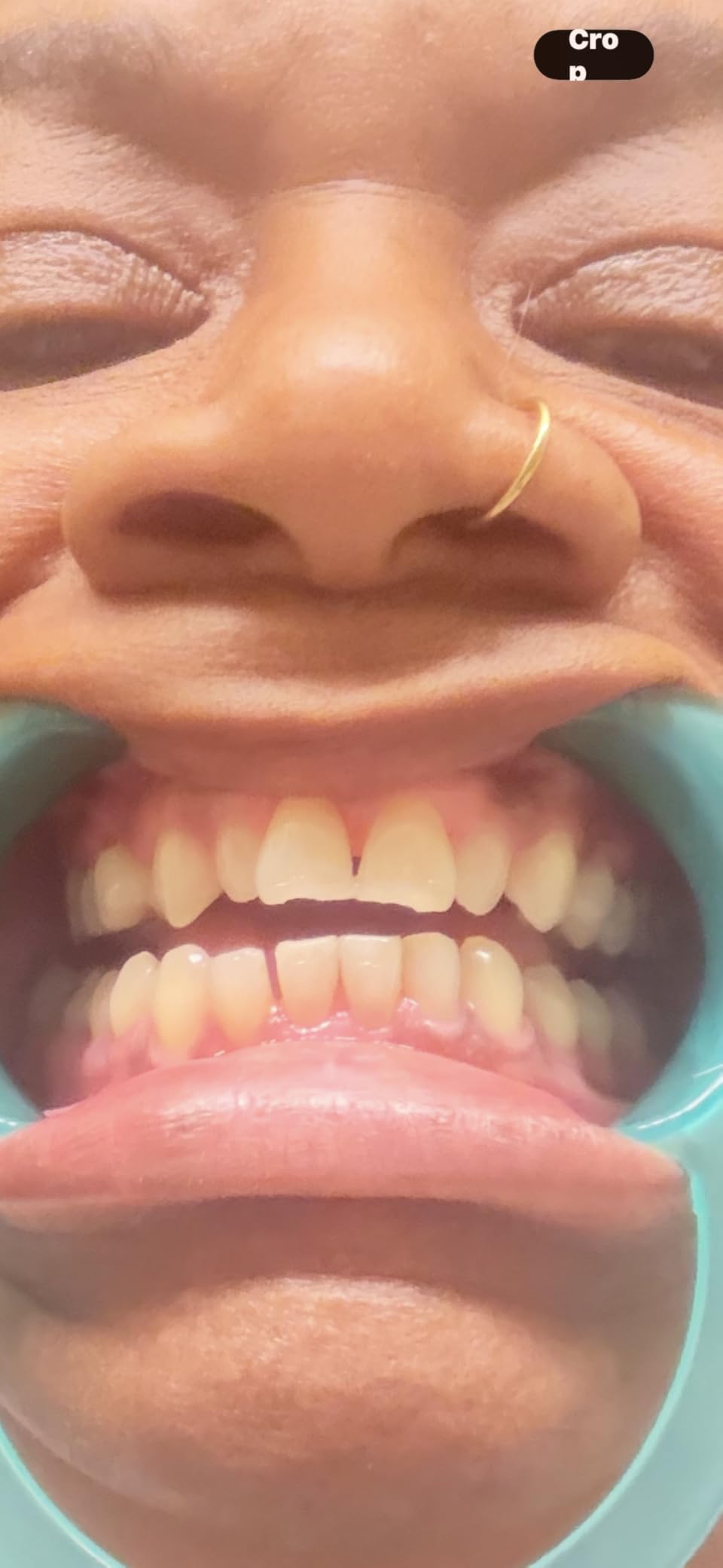 GuruNanda Teeth Whitening Kit, Up to 10 Shades Whitening, 40 Treatments customer photo 2