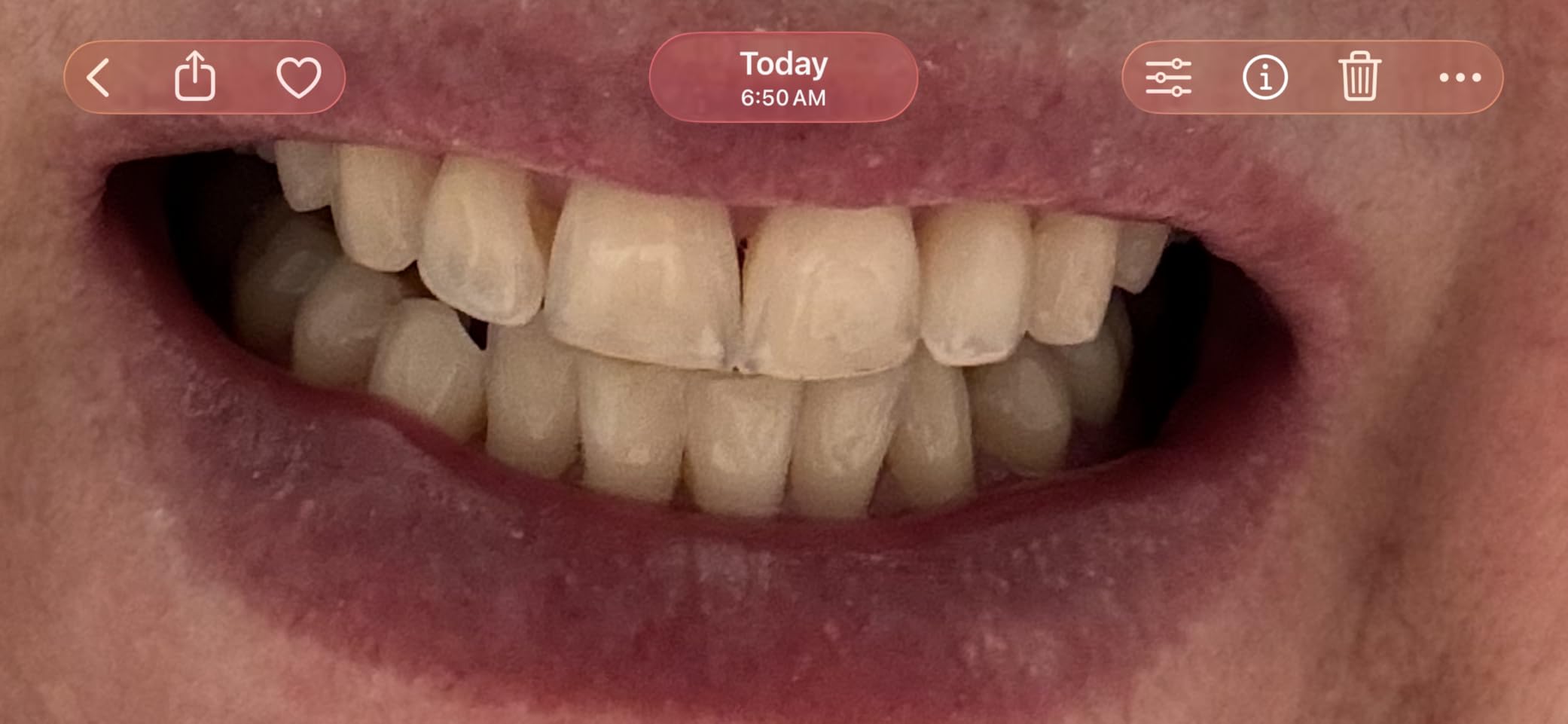 GuruNanda Sensitive Teeth Whitening Strips, Gentle & Safe, 9 Day Treatment | Visible Results in 1-Week | Non-Slip 4 Layer Dry Strip Technology | Has Coconut Oil | Gentle on Enamel customer photo 1