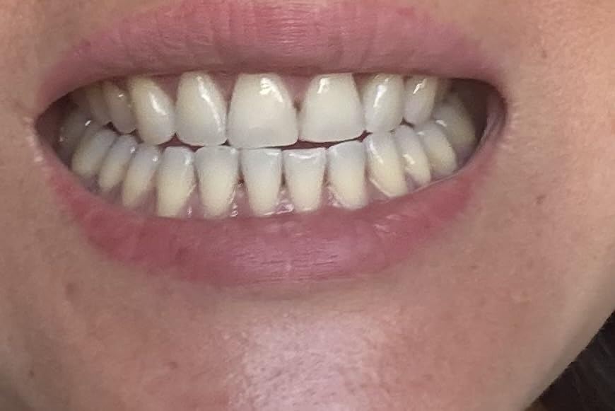 Teeth Whitening Pen Kit, Enamel-Safe Formula, No Pain for Sensitive Teeth customer photo 1