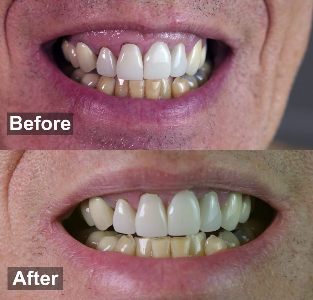 Purple Teeth Whitening Strips for Sensitive Teeth 28 Count Whitener Strips | Tooth Whitening Strips with Non Slip & Enamel Safe & Non Sensitive, Teeth Whitening Kit for Coffee Wine Stains Removal Fastly customer photo 2
